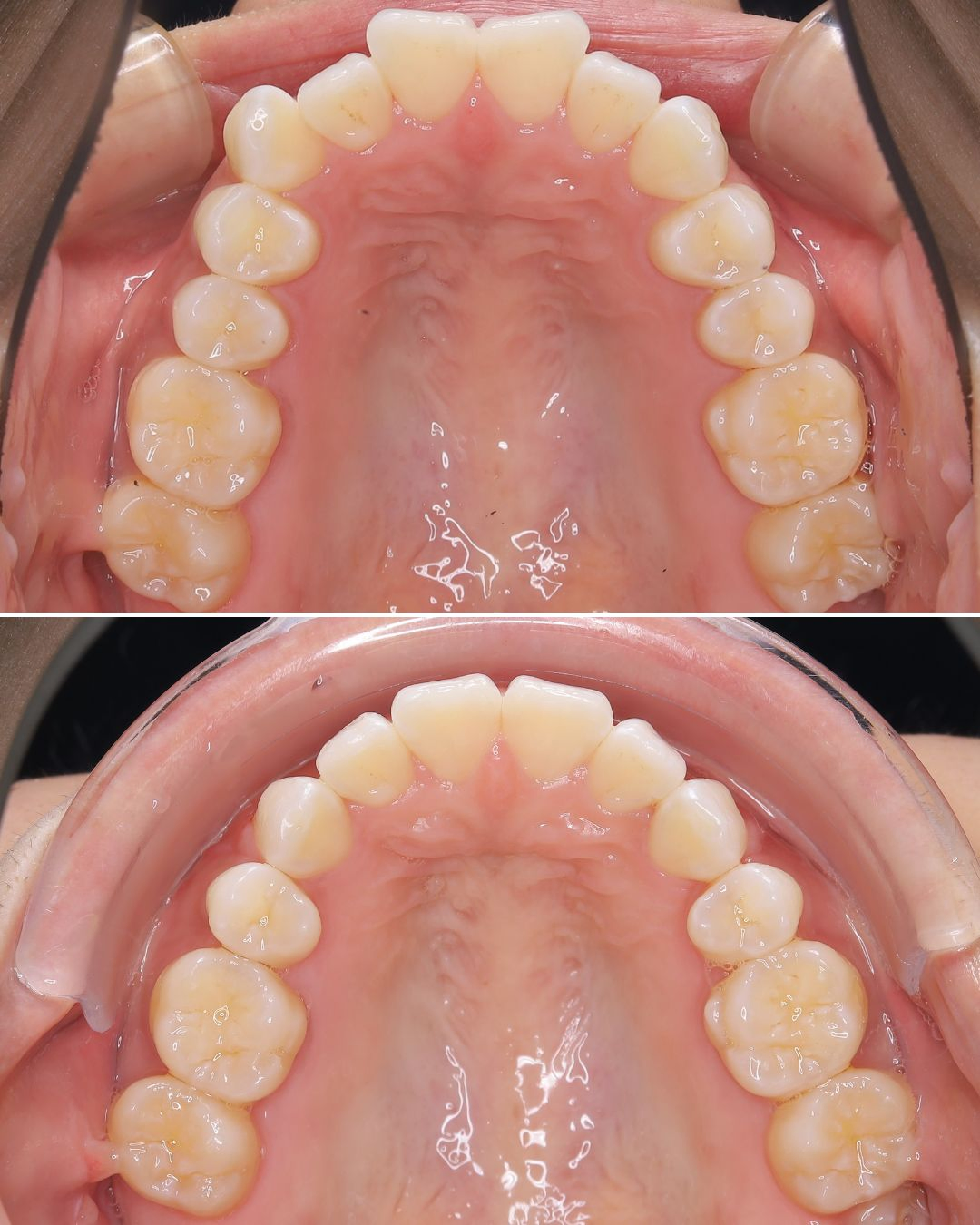 Maxillary occlusal comparison before and after treatment